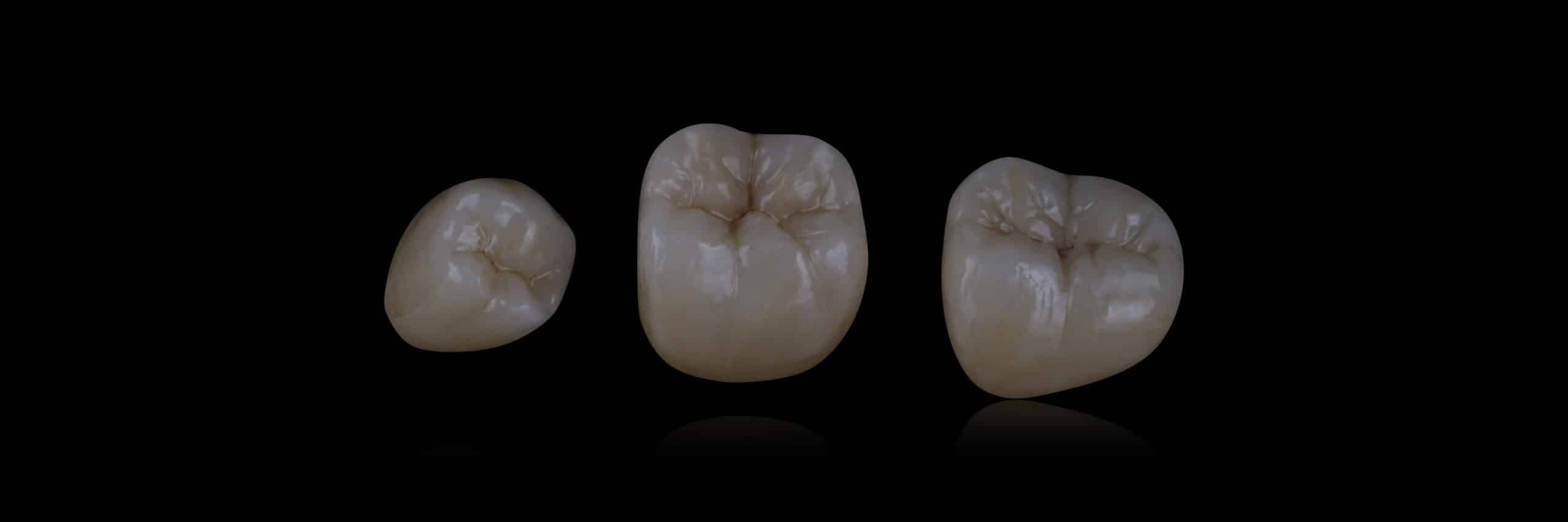 dentista faccette dentali veneers a Bergamo