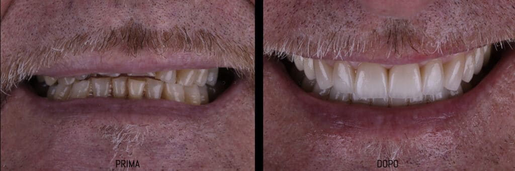 dentista faccette dentali veneers a Bergamo